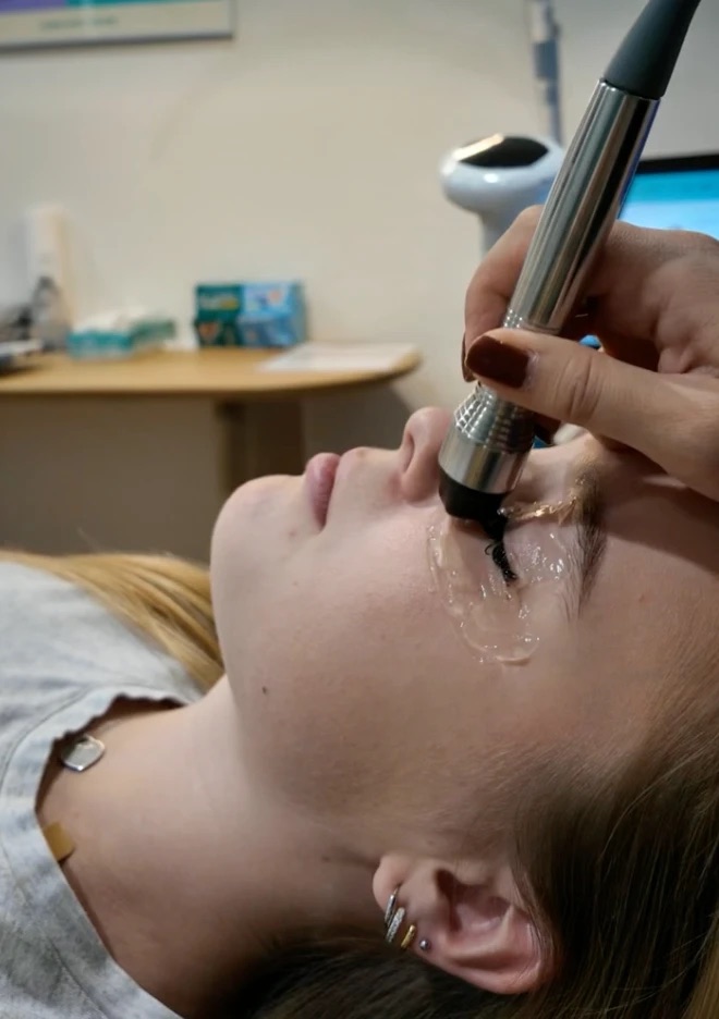Radiofrequency dry eye treatment being performed at Aura Eye Center